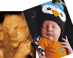 Prenatal Ultrasounds